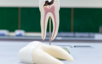 ¿Extraer un diente o endodoncia?