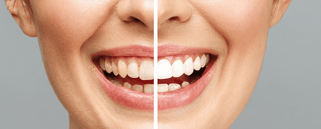 blanqueamiento dental