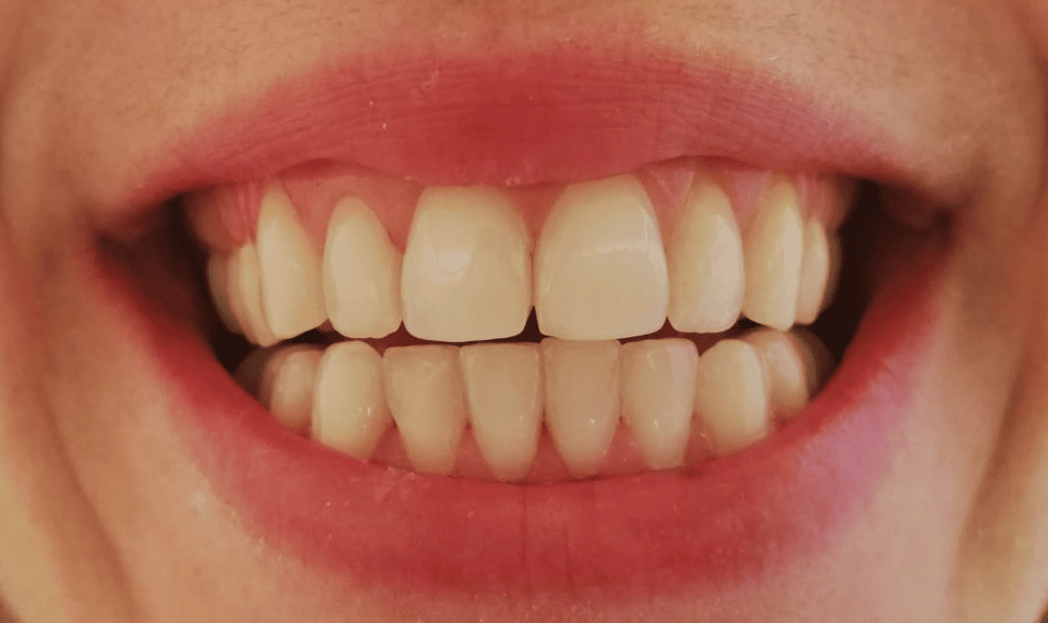 blanqueamiento dental antes