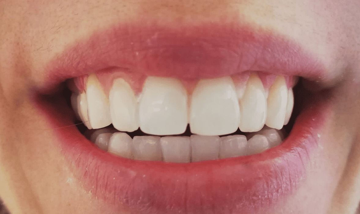 blanqueamiento dental despues