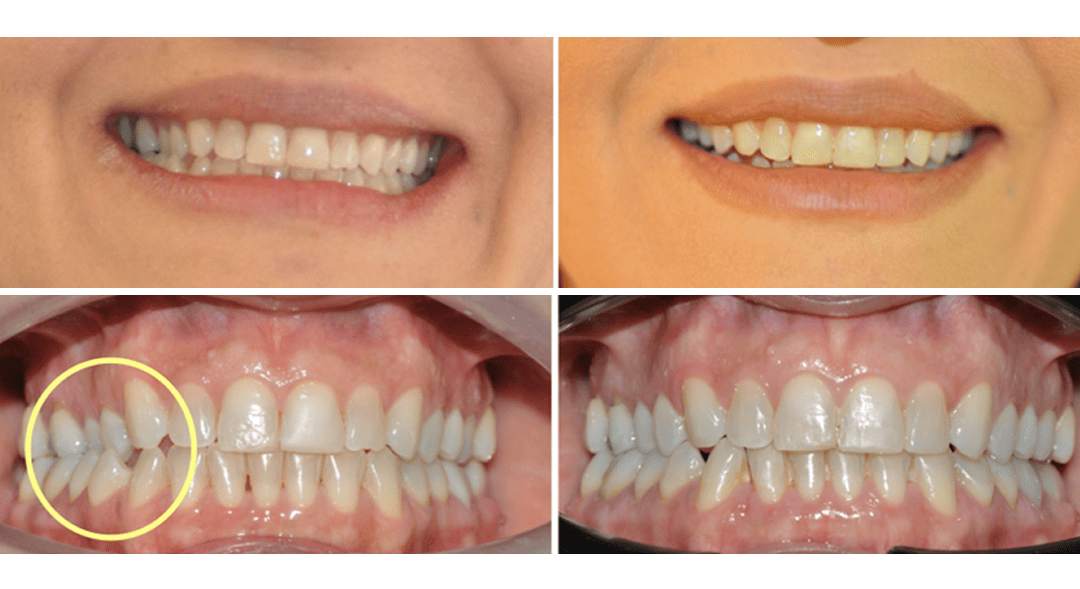 Maloclusión dental: qué es, tipos y síntomas