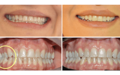 Maloclusión dental: qué es, tipos y síntomas