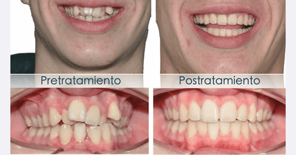mordida por apinamiento