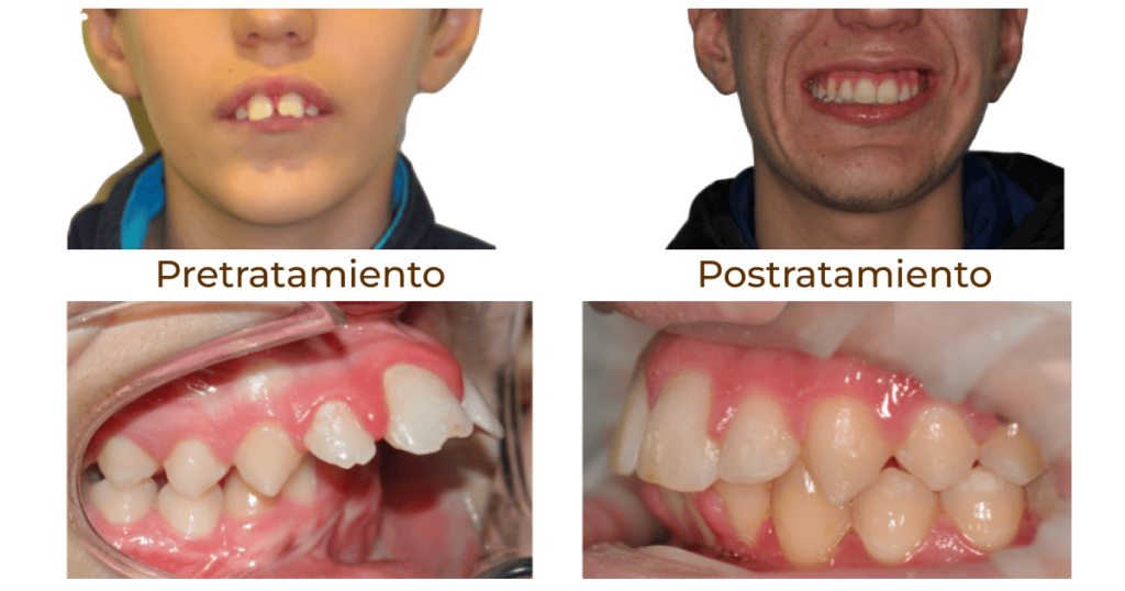 ortodoncia funcional