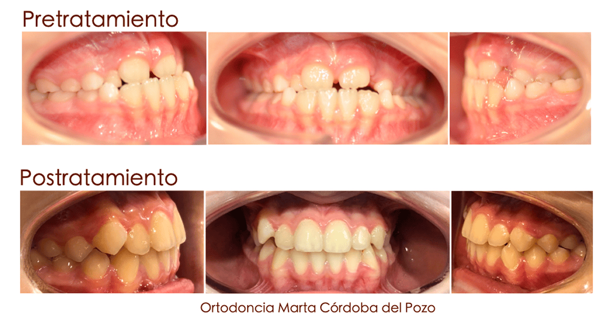 ortopedia dental infantil