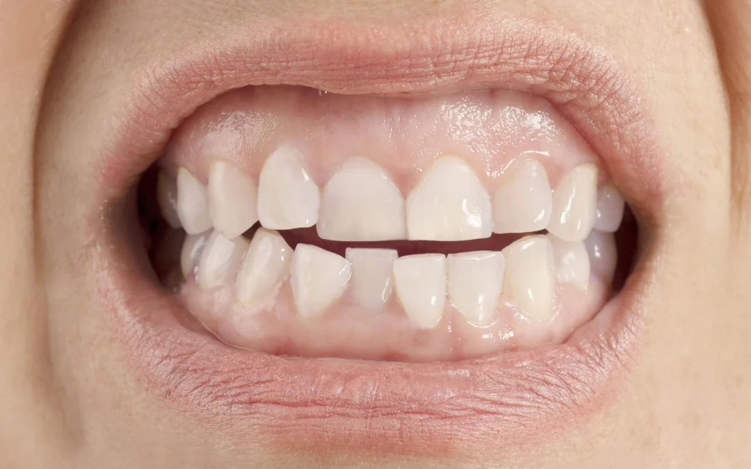 Causas y tratamiento para la maloclusión dental