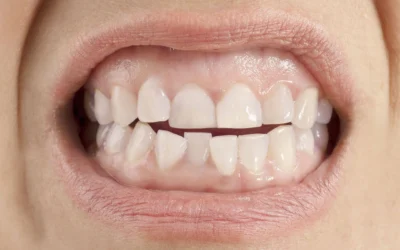 Causas y tratamiento para la maloclusión dental